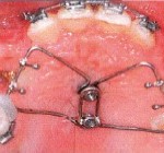Inclusions dentaires multiples. Le fil en forme de papillon soudé sur les deux suprastructures offre de nombreux points d’ancrage pour les chaines élastiques.