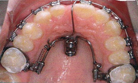 Mésialisation unilatérale des dents postérieures du maxillaire par ancrage direct. 