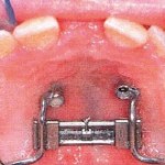 Disjonction intermaxillaire rapide et protraction du maxillaire, Hybrid-hyrax
En l'absence d'un ancrage dentaire antérieur, il est possible d’insérer deux mini implants de chaque côté de la suture palatine. La distance entre les deux implants était initialement de 5mm.