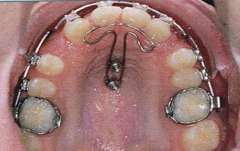 Mésialisation bilatérale des dents postérieures du maxillaire On obtient une fermeture de l’espace en ajoutant un ancrage indirect soutenu par un implant.