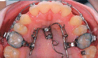Mésialisation bilatérale des dents postérieures du maxillaire par ancrage direct. 