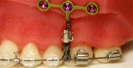 Ingression unitaire ou sectionnelle par modules Relier l'un des crochets de la plaque à une dent ou à l'arc orthodontique
